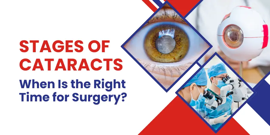 Stages of Cataracts When Is the Right Time for Surgery featured image Stages of Cataract When Is the Right Time for Surgery- featured image