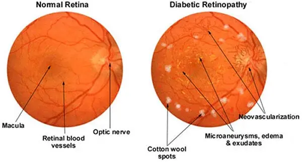 Difference Between Normal Retina and Diabetic Retinopathy