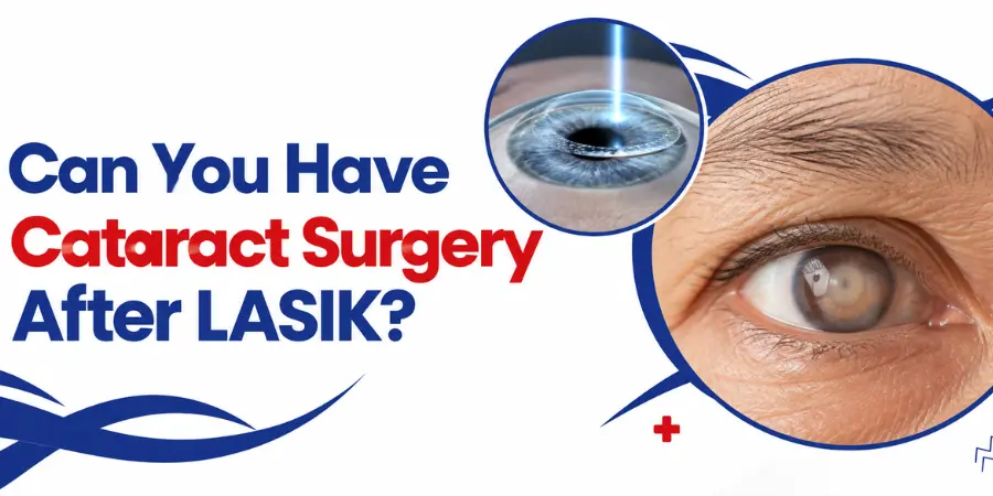 Can You Have Cataract Surgery After LASIK - featured image
